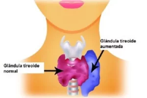 Hipertireoidismo Alimentação e efeitos