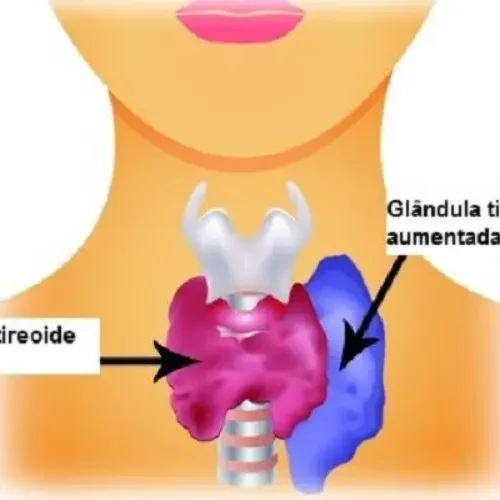 Hipertireoidismo Alimentação e efeitos