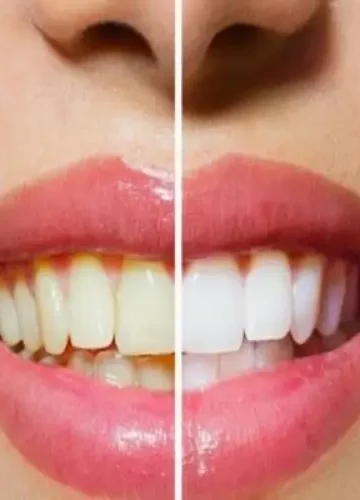 Dicas para clarear os dentes em casa naturalmente.